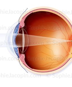 IMPLANTS INTRA-OCULAIRES