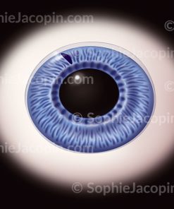 GLAUCOME – IRIDECTOMIE AU LASER